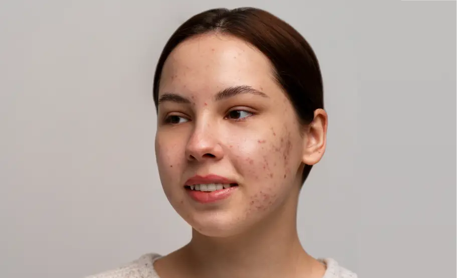 Before treatment acne skin